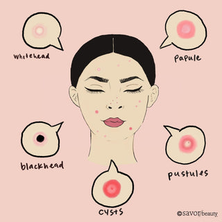 All Pimples Are Not Created Equal