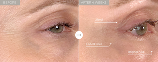 Before and after comparison of eye area treatment showing lifted, faded lines, and brightened skin.