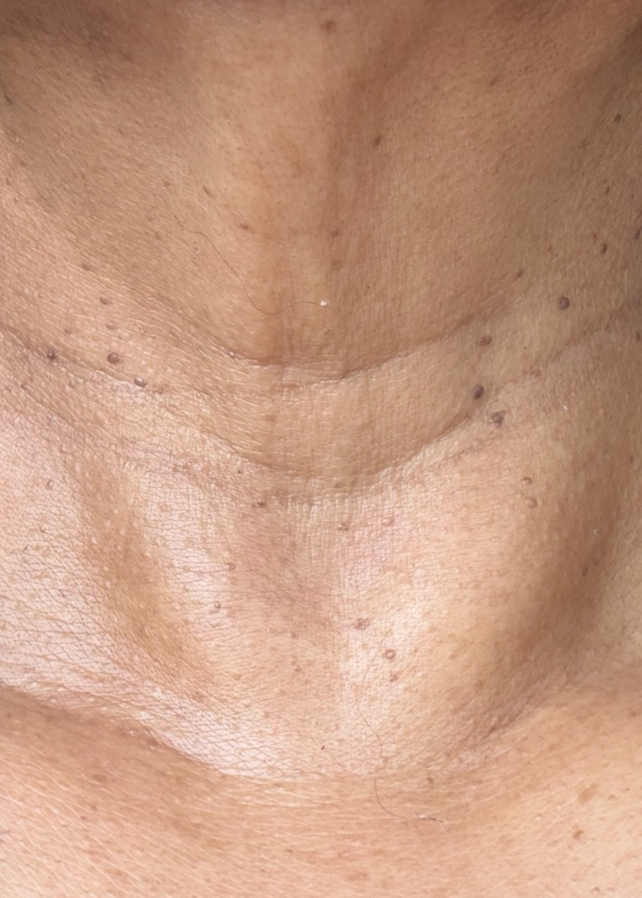 Close-up of a person's neck and upper chest area, showing skin texture and a leopard-print garment at the shoulders.